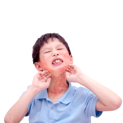 childeczema_edited.png