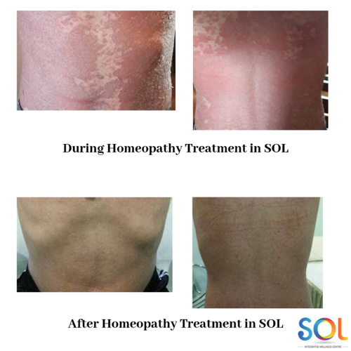 During Homeopathy Treatment in SOL (1).p